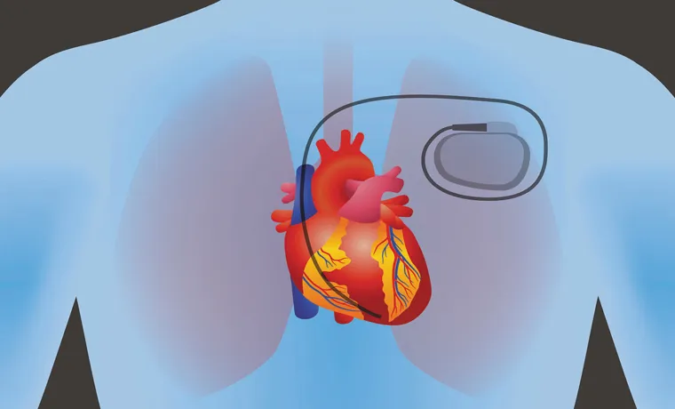 What Happens If You Go Through a Metal Detector with a Pacemaker: Explained