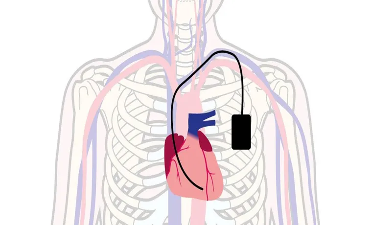 what happens if you walk through a metal detector with a pacemaker